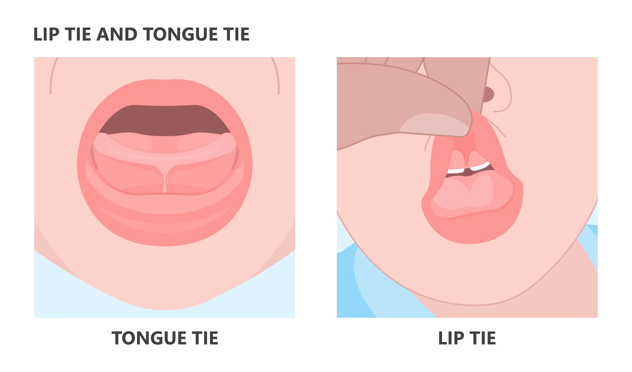toungue-tie and lip-tie illustrations