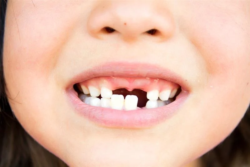 Baby Bottle Tooth Decay Causes, Signs & Prevention