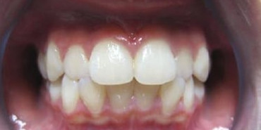 Orthodontic Treatment