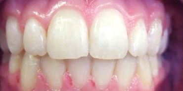 Orthodontic Treatment