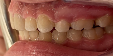 Braces