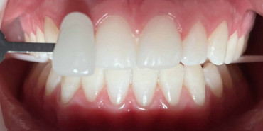 Whitening After Orthodontic Treatment