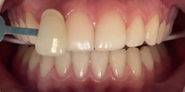 Whitening After Orthodontic Treatment