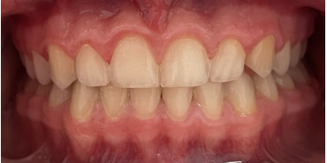 Orthodontic Treatment