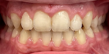 Phase Full Braces