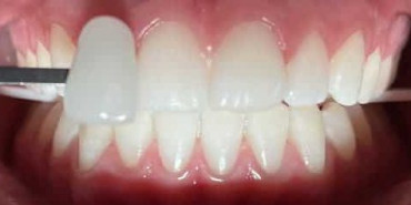 Whitening