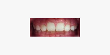 Orthodontic Treatment