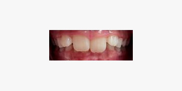 Orthodontic Treatment