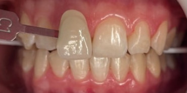 Whitening